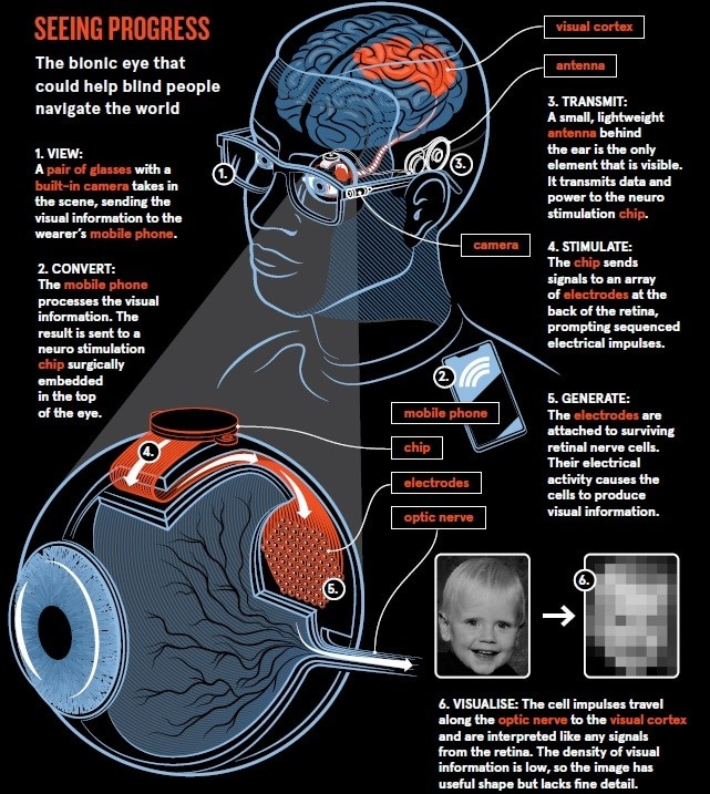 Detailed infographic of how the bionic eye that could help blind people navigate the world..