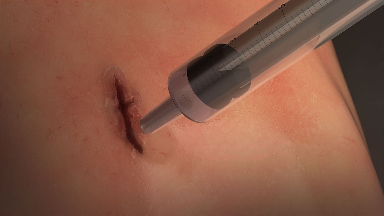 MeTro surgical glue being applied to a wound