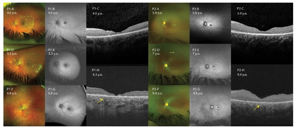Multimodal retinal imaging follow-up for selected patients