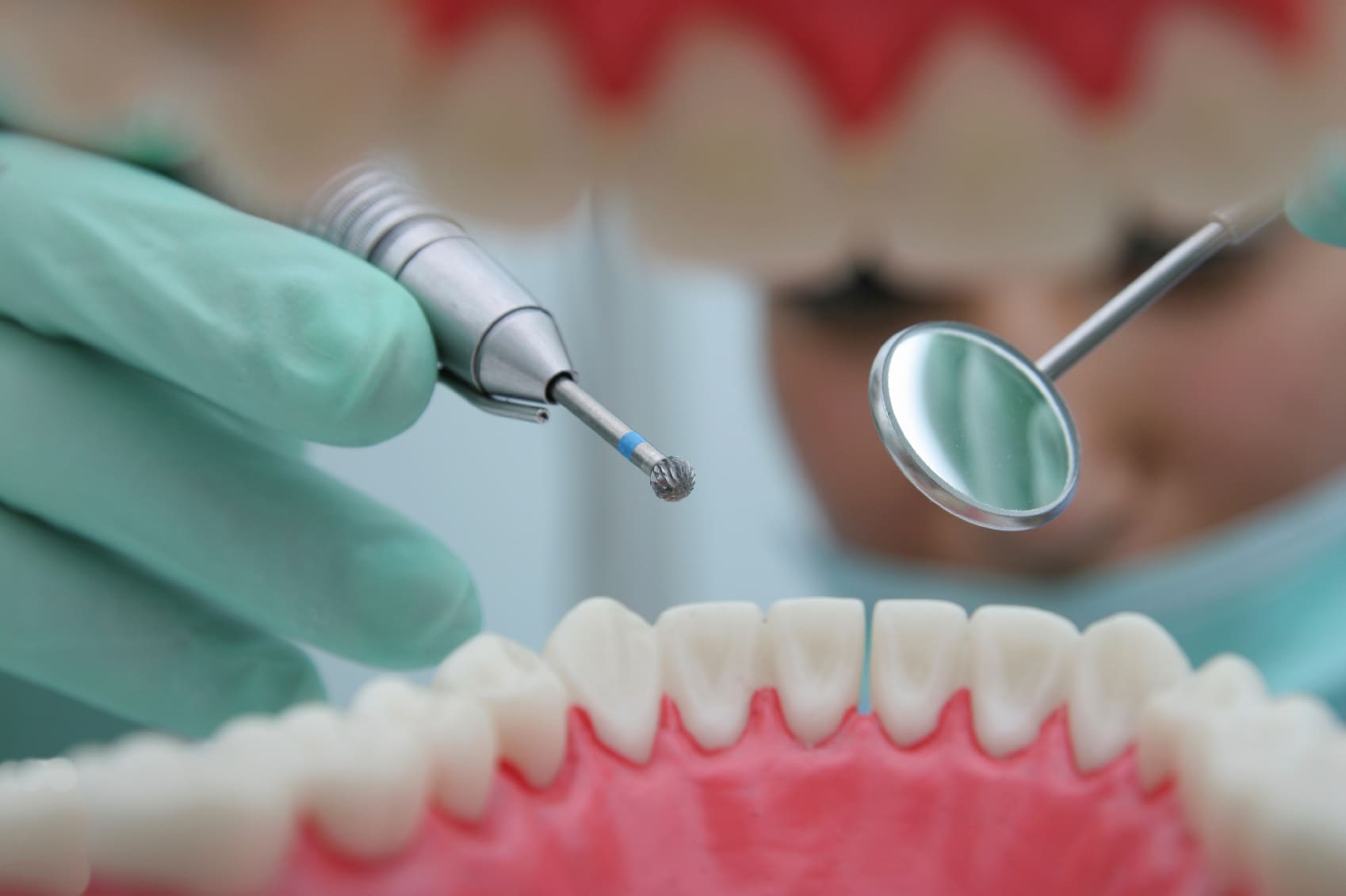 â€œNodrillâ€ dentistry stops tooth decay new research
