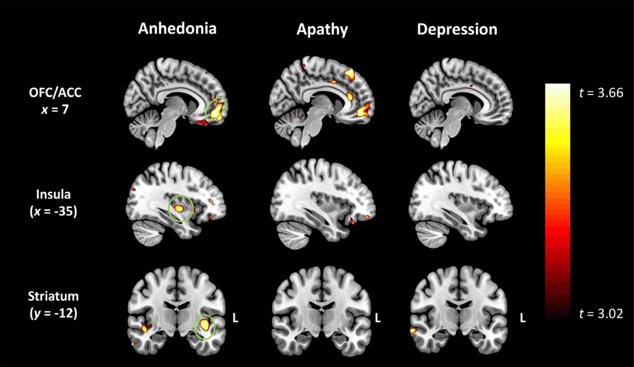 Neuroimaging findings show grey matter intensity decreases related to anhedonia, apathy and depression. Anhedonia in FTD was related to degeneration of the regions circled in green, which are ‘hedonic hotspots’ (related to reward-seeking) in the brain. Credit: University of Sydney.