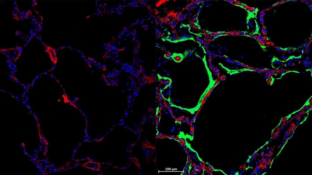 Left: Control Lung. Right: Immunofluorescent staining shows expression of new SARS-CoV-2 spike-receptor LRRC15 (green) in post-mortem lung tissue section from individual with COVID-19 [Credit: Loo and Waller et al.]