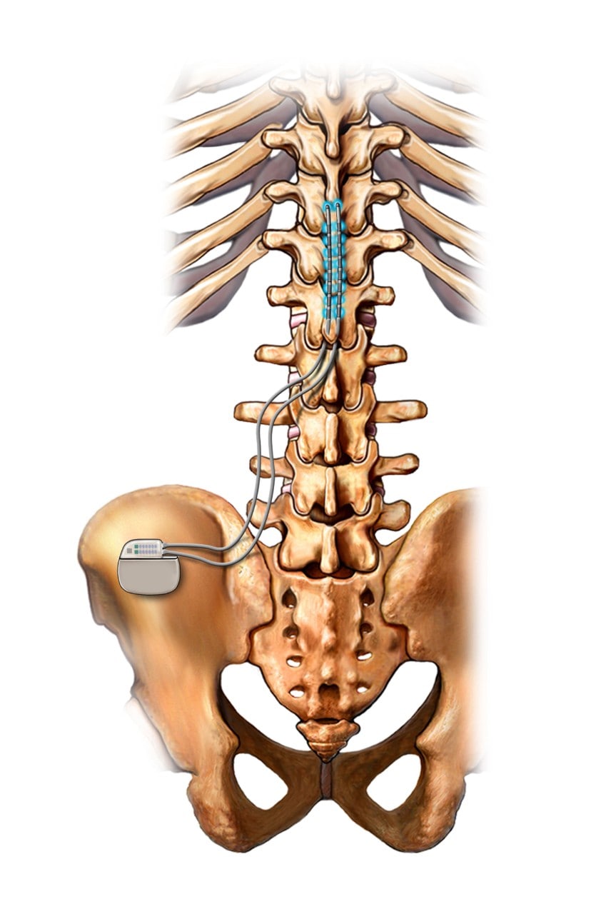 Diagram of a spinal cord simulator device attached to a spine