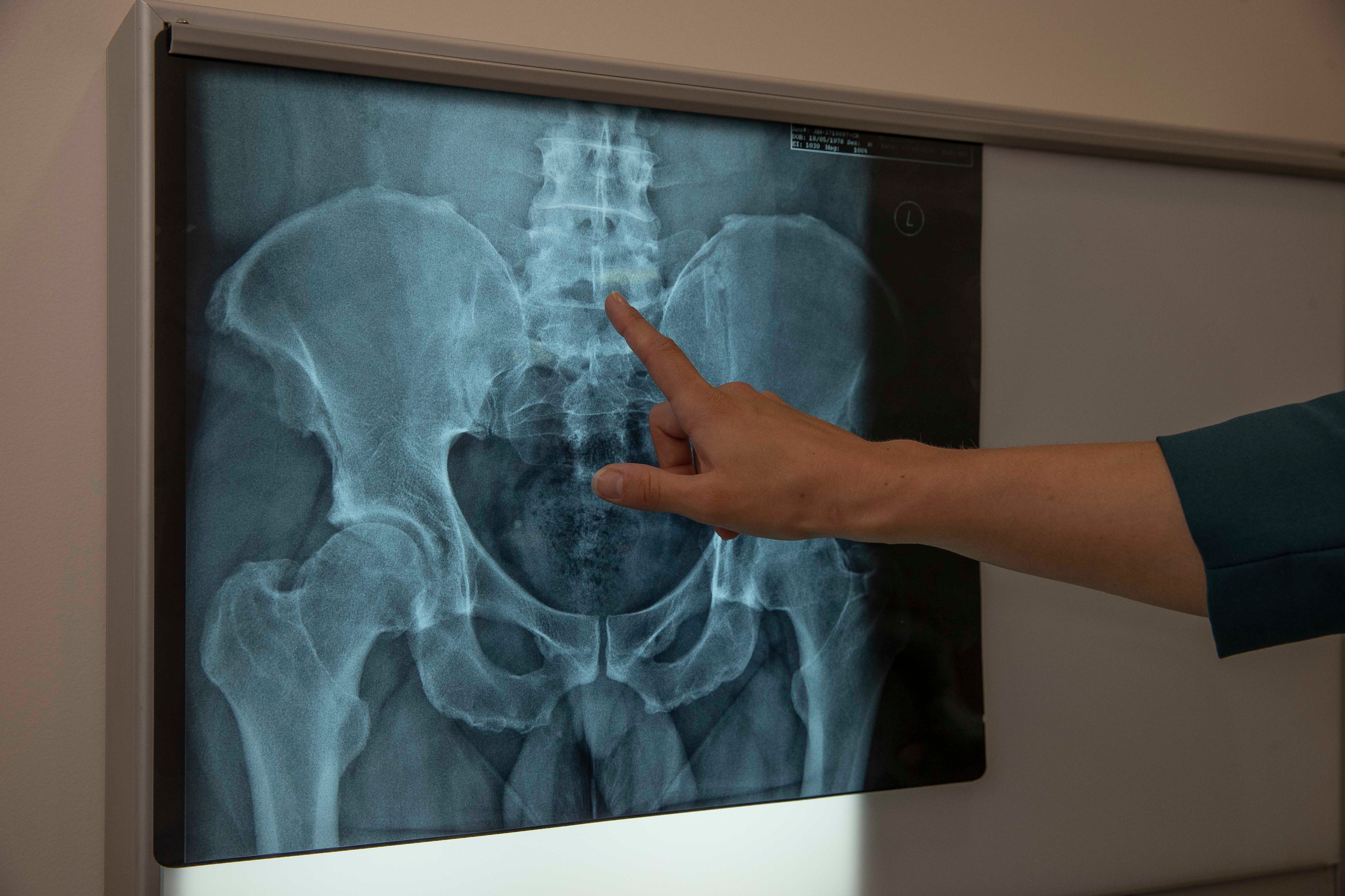 Spinal cord stimulation doesn t help with back pain says new review - The  University of Sydney