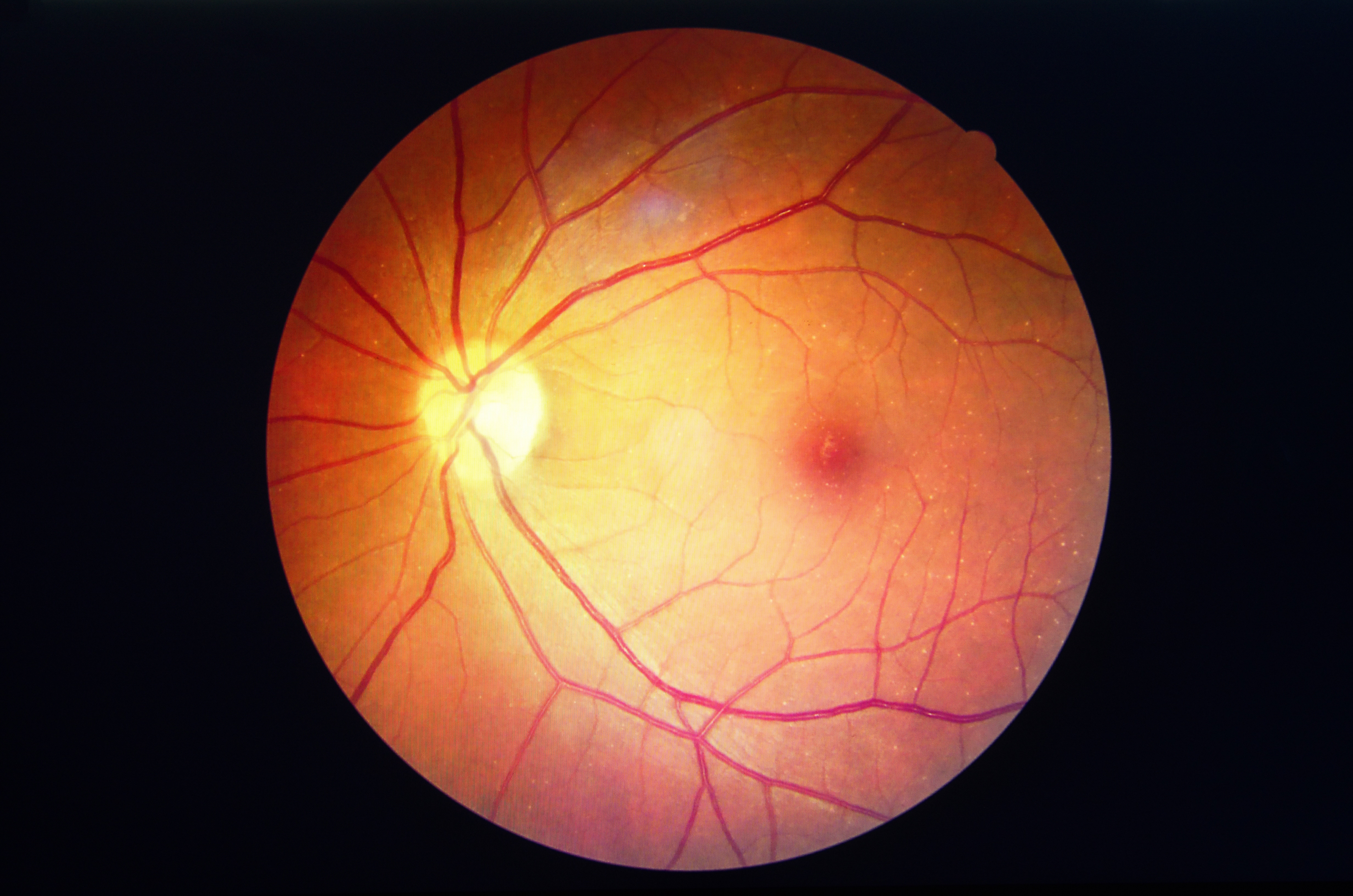 На сетчатку глаза за 3 с. Непролиферативная диабетическая ретинопатия. Ангиопатия и ретинопатия сетчатки. Диабетическая ретинопатия глазное дно. Непролиферативная диабетическая ретинопатия глазное дно.