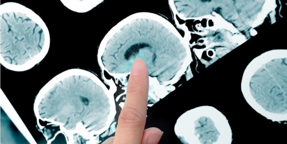 Parkinsons