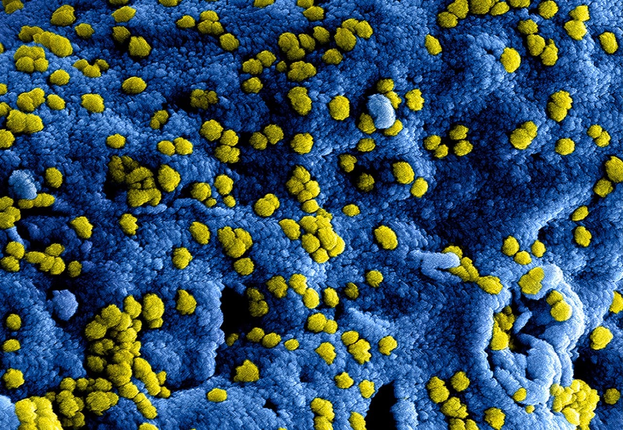 A highly magnified, digitally colorized scanning electron microscopic image, revealing ultrastructural details of numerous yellow colored, Middle East respiratory syndrome coronavirus (MERS-CoV) viral particles.