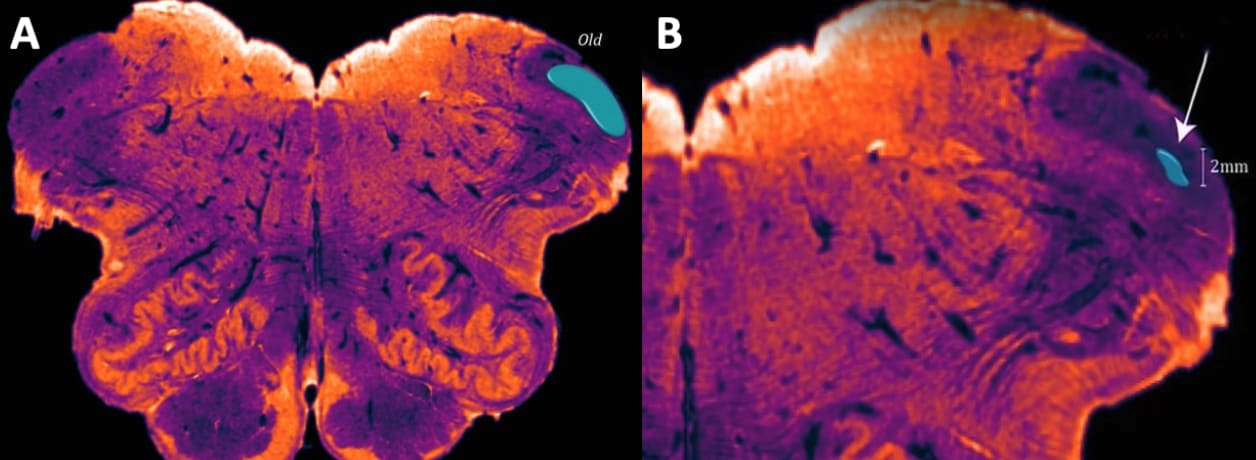 Brain scan showing the medulla