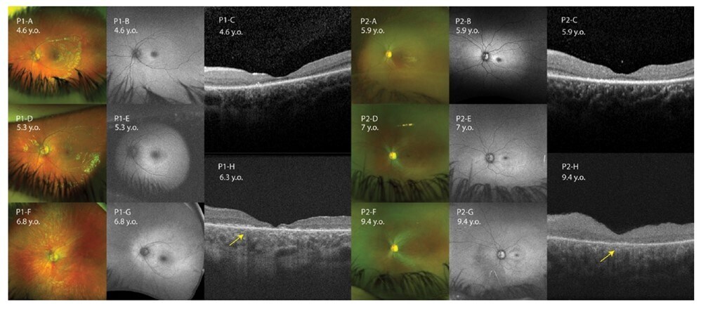 Multimodal retinal imaging follow-up for selected patients