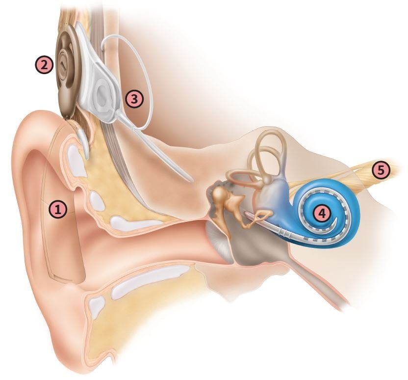 Graphic of Cochlear implant