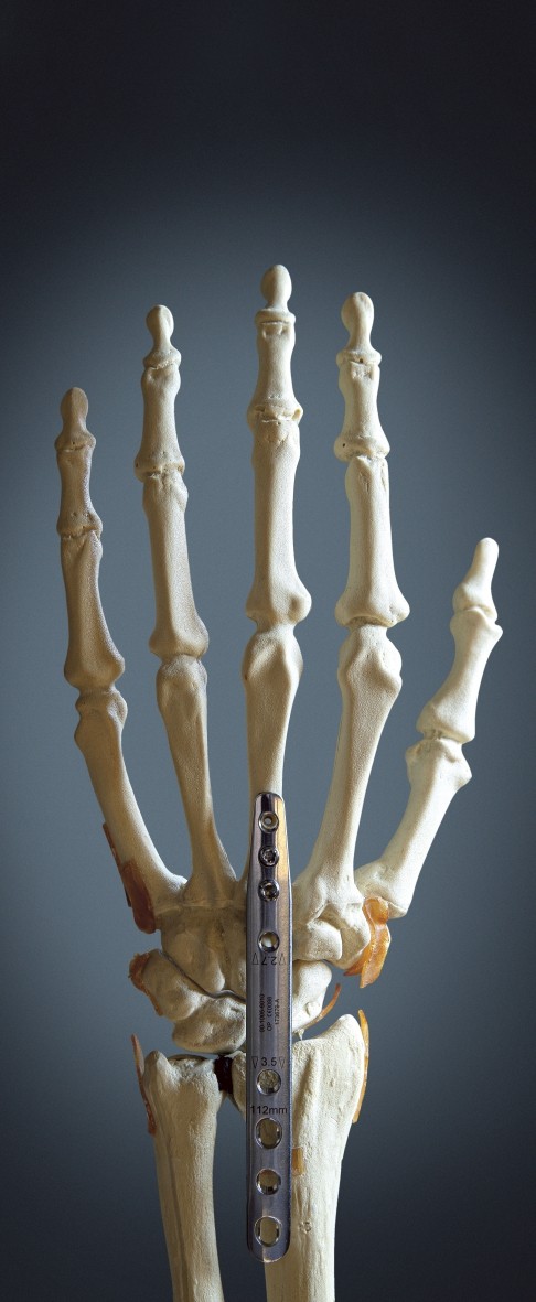 An artificial, though realistic skeleton of a human hand, with the back of the hand facing the camera. We can see that from below the wrist to half way up the hand, there is a narrow metal brace attached. The picture has a luminous grey background.