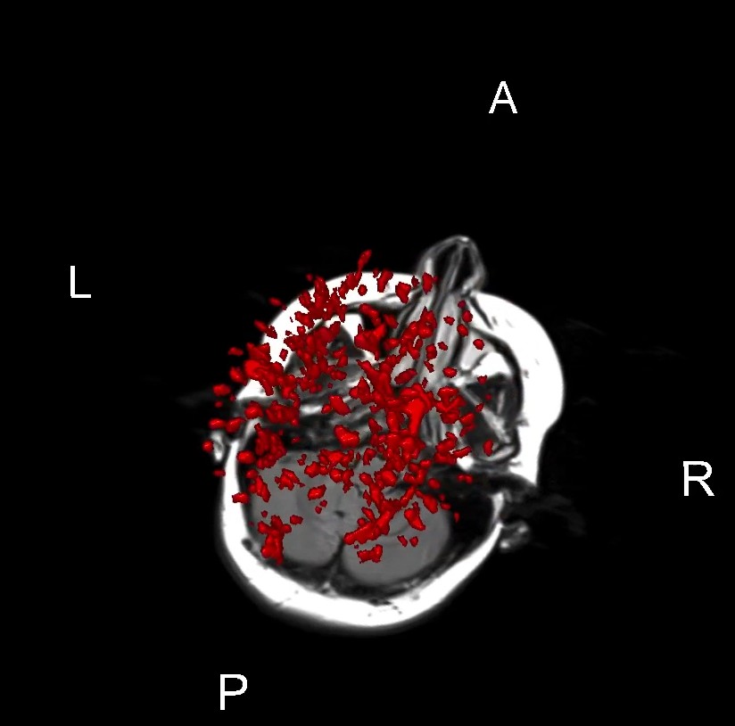 Scanned image showing 3D segmentation of multiple sclerosis ‘lesions’ (red) from a patient with relapsing and remitting disease. Credit for images: Dr Tim Wang/Sydney Neuroimaging Analysis Centre 