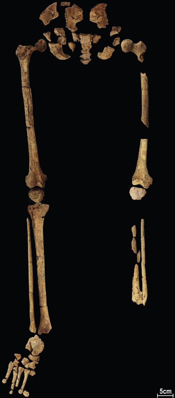Bones of left and right legs with pelvic girdle demonstrating the complete absence of the left lower leg and foot.