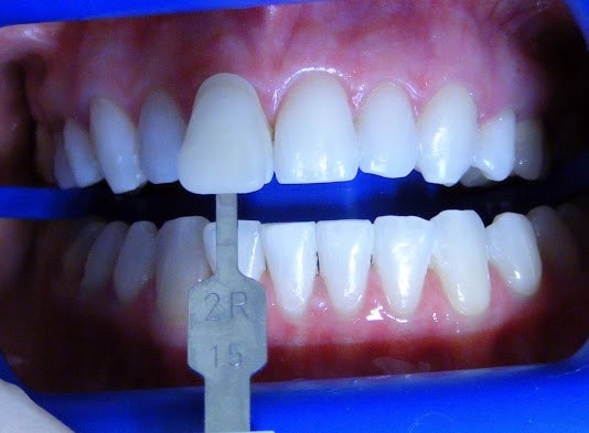 Teeth being whitened