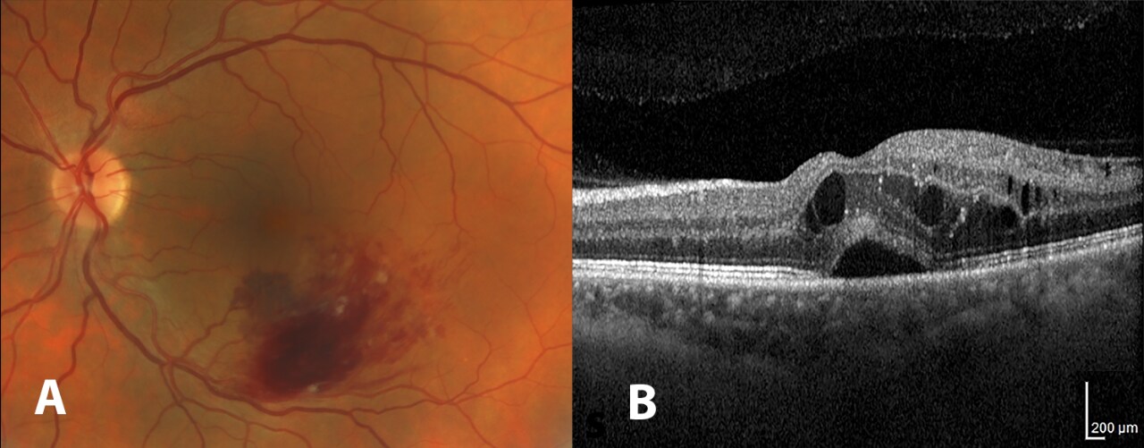 Clinical images of a retinal vein occlusion