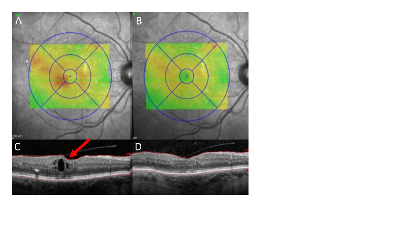 Pre (A&C) and Post (B&D) near infrared light treatment course for macular oedema due to diabetic retinopathy
